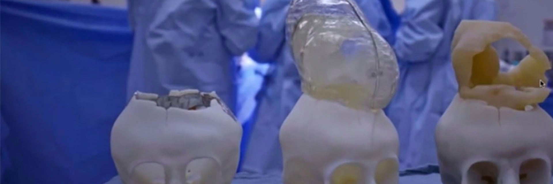 Three anatomical models of a baby's skull with the brain outside in an operating room with a group of surgeons in the background