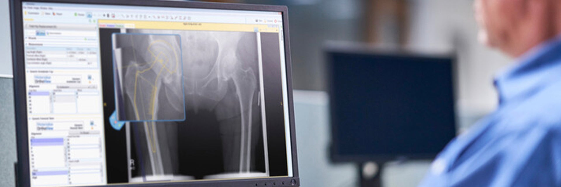 Person looking at a computer screen with medical surgical planning software