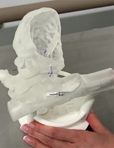 3D-Printed Simulator for Transcatheter Edge-to-Edge Repair (TEER)