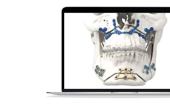Materialise Personalized CMF solutions shown on a skull.
