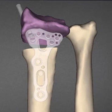 3D Osteotomy Planning with the Clinical Engineer