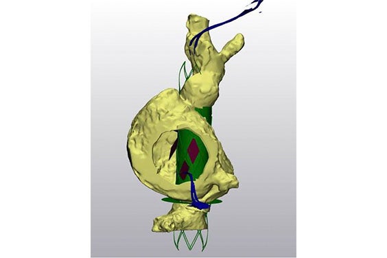 Digital planning of a valve replacement