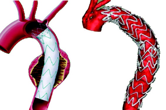 Thoracic Aortic Aneurysm 3d Thoracic Aortic Aneurysm Newport Cardiac