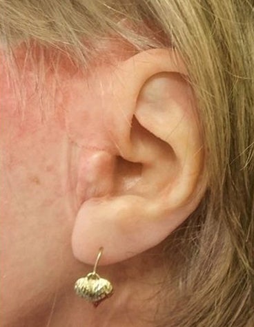 The ear prosthesis in place.