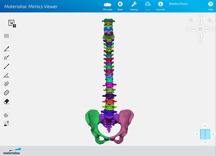 A screenshot of a spine in Mimics Viewer.