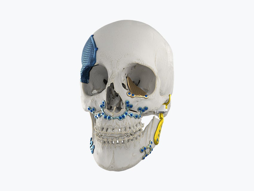 3D skull model with various plates and implants attached