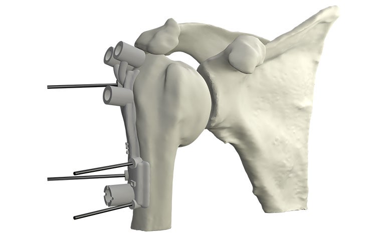 materialise-osteotomies-solutions-3d-printed-guides-indication-shoulder-model.jpg