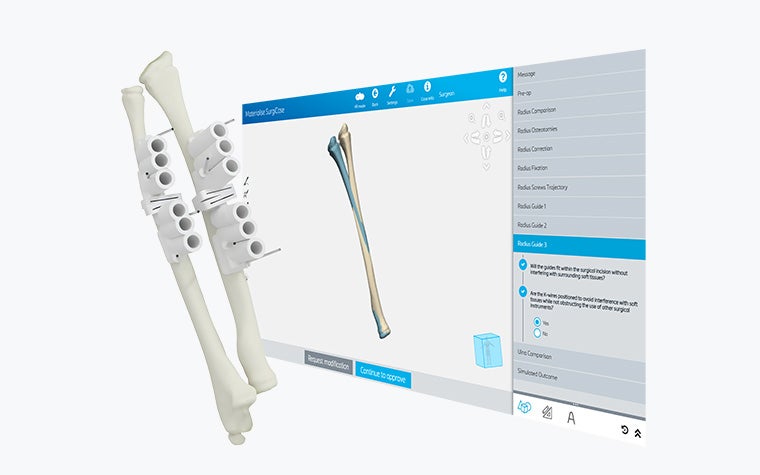 Zwei Knochenmodelle mit 3D-gedruckten, personalisierten Bohrschablonen vor einem Bildschirm mit der Anatomie des Patienten in Materialise SurgiCase