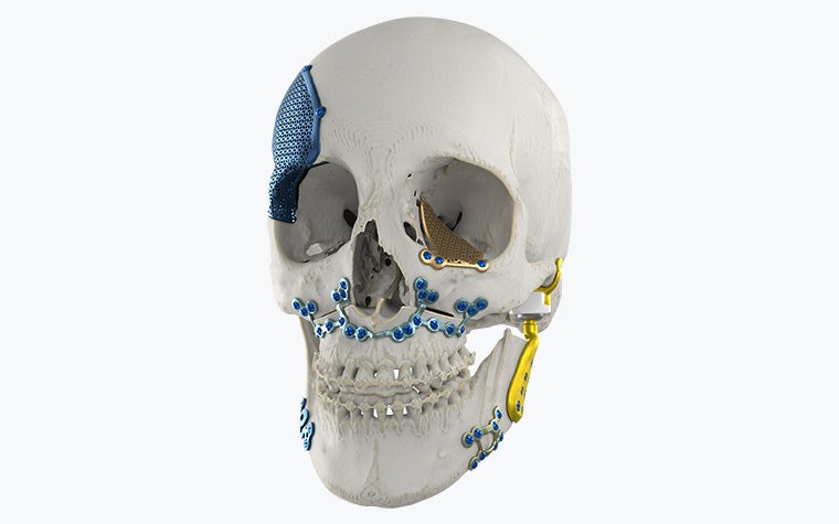 3D skull model with various plates and implants attached
