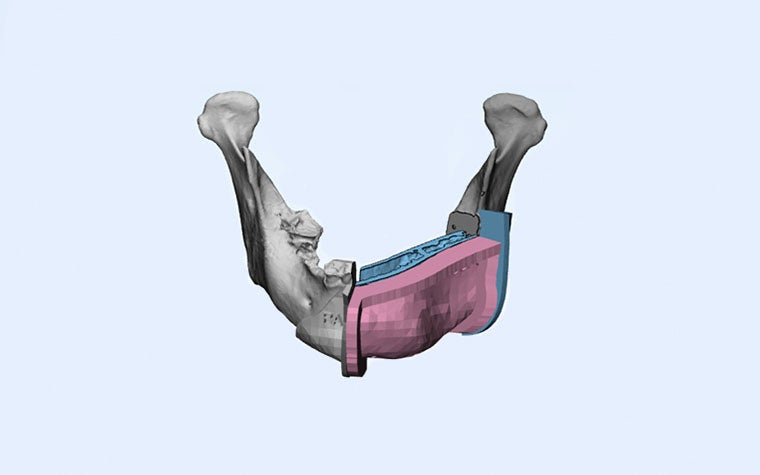 Computer model of a 3D-printed surgical guide on a patient's jaw