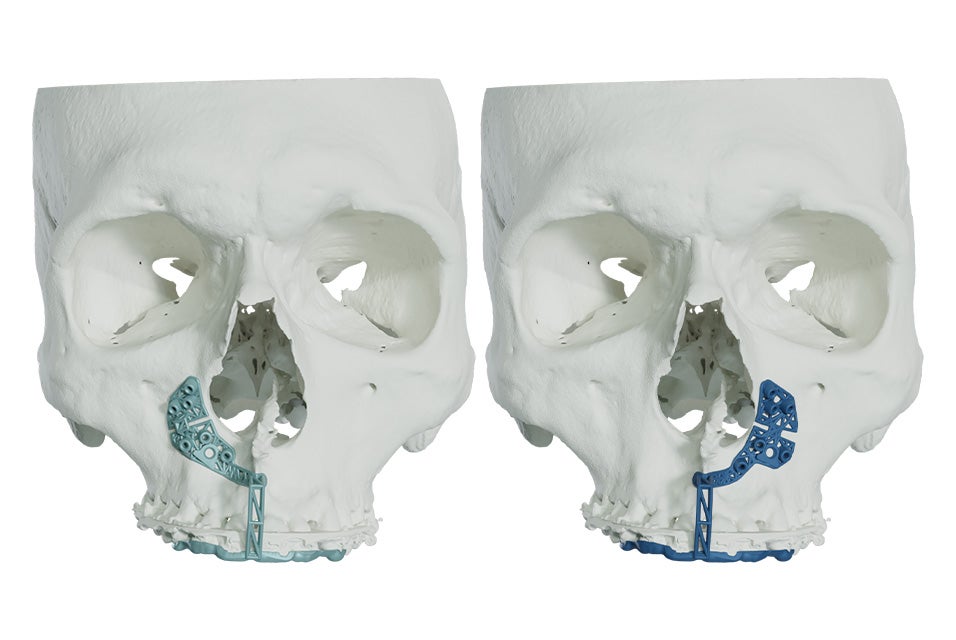 Two front facing skulls side by side with 3D-printed tooth-supported minimally invasive guides in use.