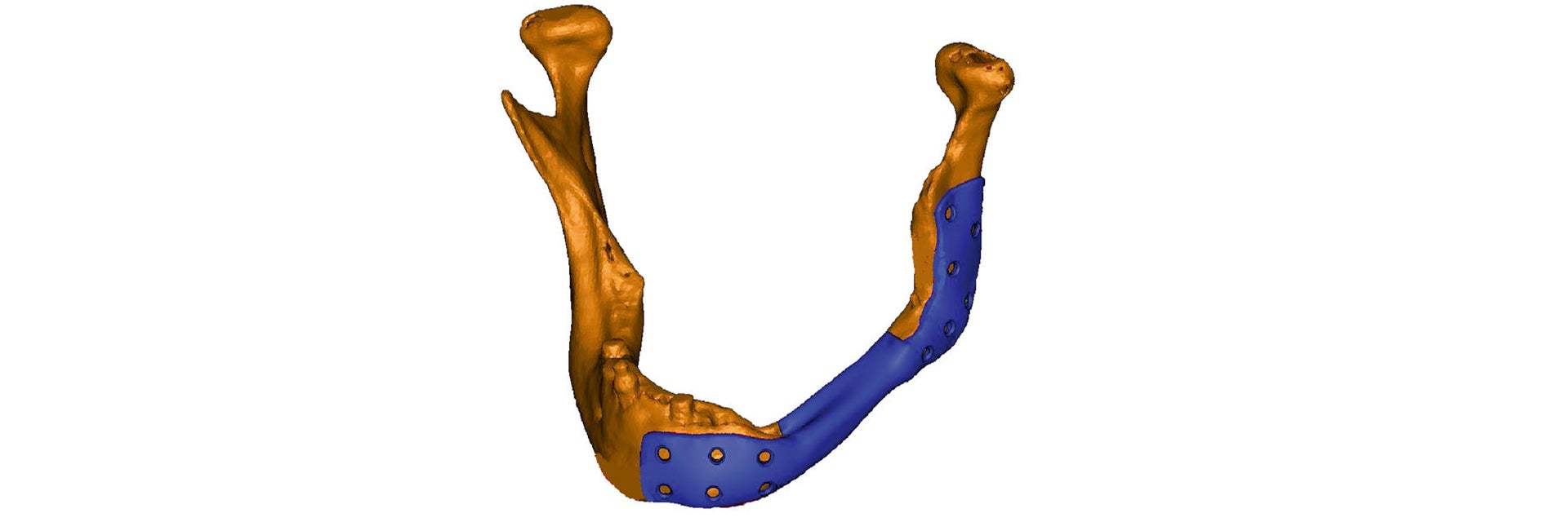 3D model of a jawbone with a personalized implant attached