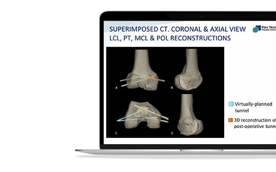 A laptop with a presentation on screen, showing superimposed CT. coronal & axial view LCL, PT, MCL, and POL reconstructions
