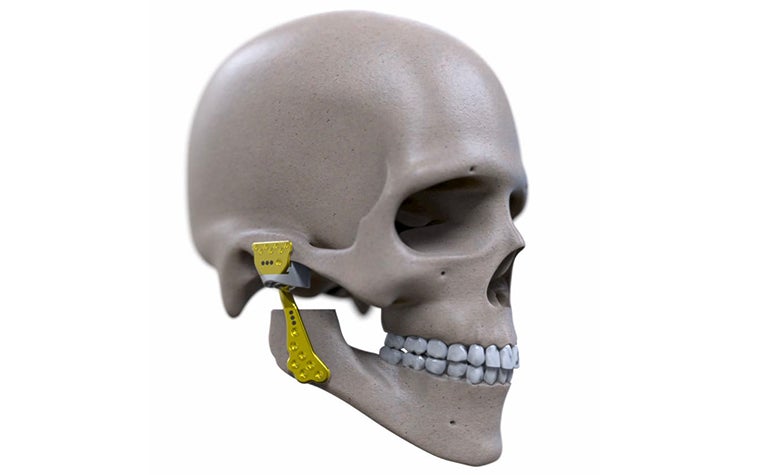 3D model of a skull with Engimplan implants for the jaw