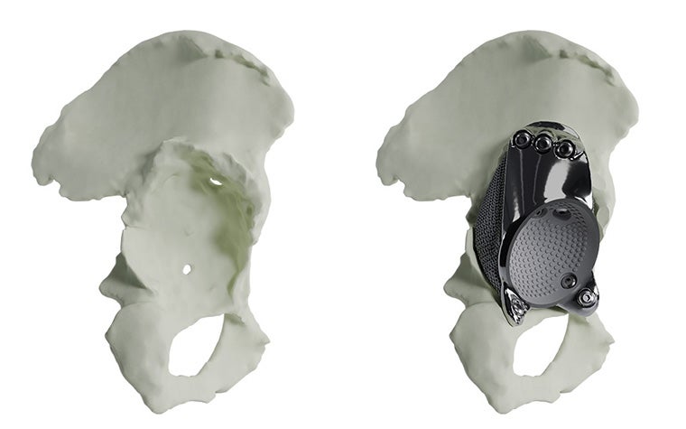 complete-acetabular-rim-loss-without-with-implant-model.jpg