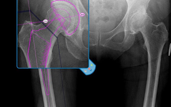 View of an X-ray of a pelvis in OrthoView
