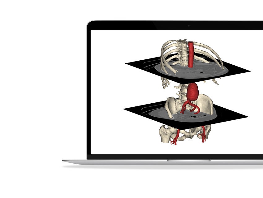 An abdominal aortic aneurysm model with the bones as reference. It shows 2 axial slices of the CT scan to show how we go from images to a 3D model.