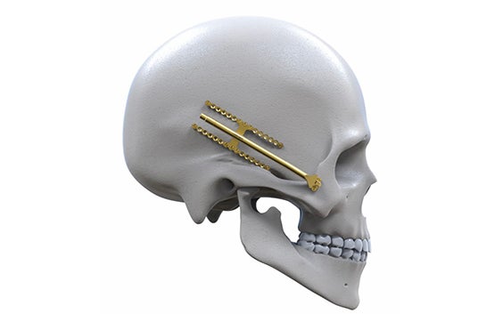 Virtual model of Engimplan implants in the skull