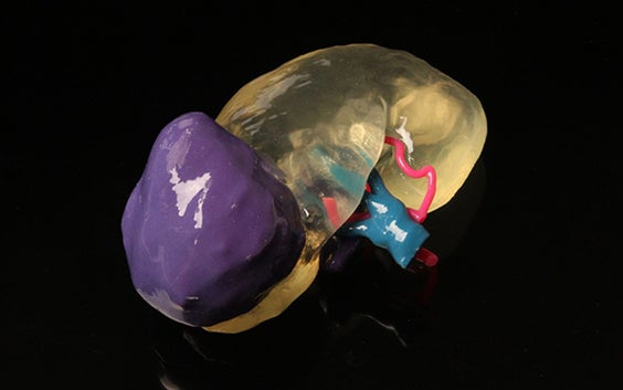 3D-Printed Kidney Model Allows Surgeons to Successfully Transplant Adult Kidney into Two-Year-Old