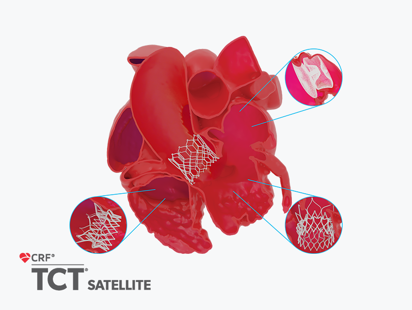 A digital illustration of a human heart with highlighted areas showing stent placements
