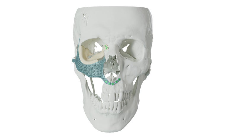 A front-facing skull with 3D-printed titanium implant for an orbital floor reconstruction.