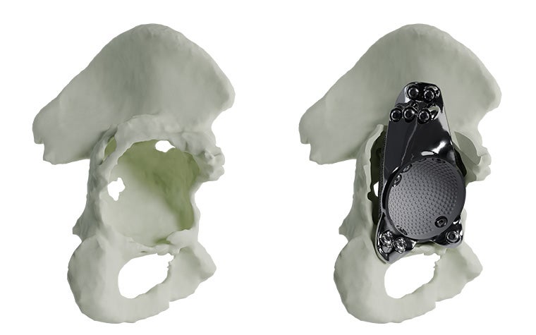 extensive-acetabular-without-with-implant-model.jpg