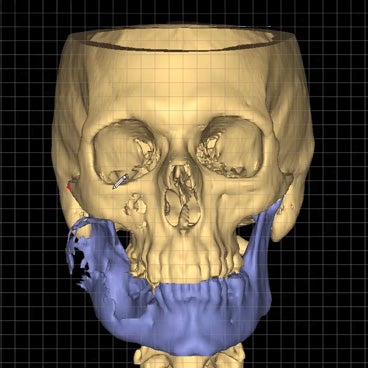 Virtual Planning for Mandibular Reconstruction Surgery with Mimics Enlight CMF