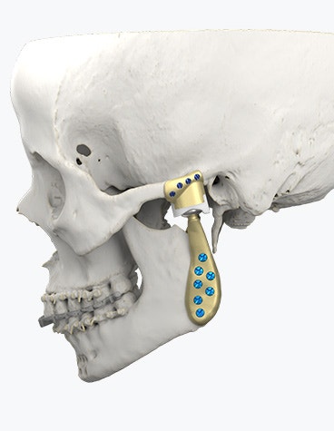 How Personalized TMJ Implants Improve Success in TMJ Arthroplasty