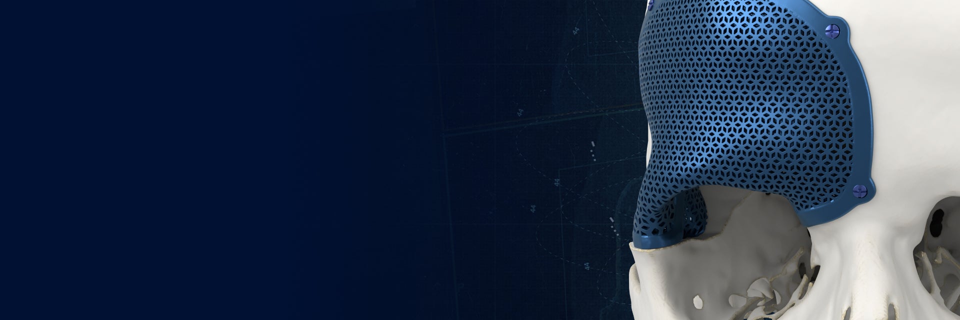 Close-up view of a porous, titanium, 3D-printed, CMF implant