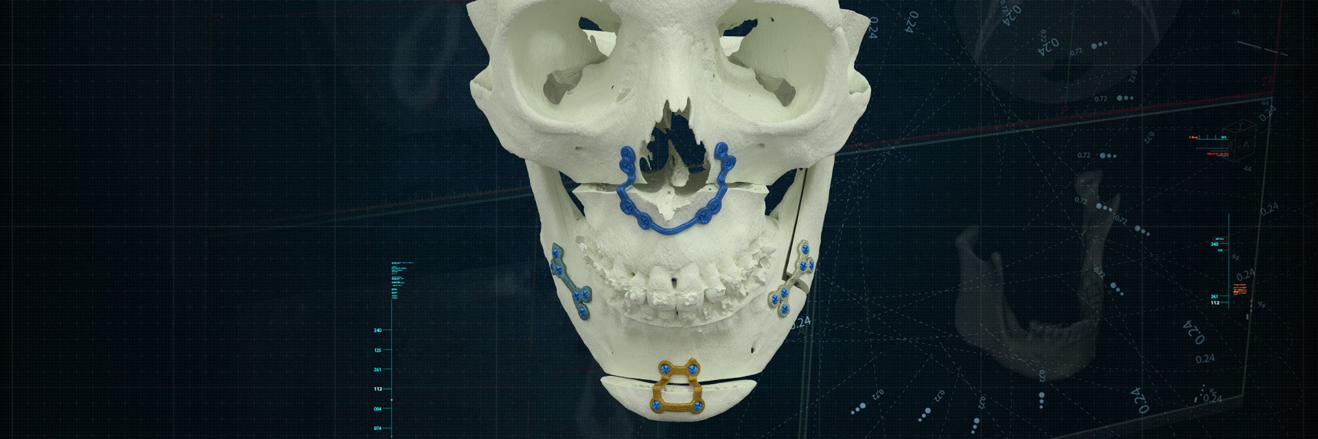 How 3D Fuels Minimally Invasive Orthognathic Surgery Success