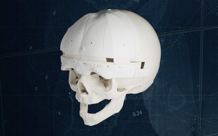 A 3D-printed anatomical model of an infant human skull with cranial cutting guides, displayed against a dark background.