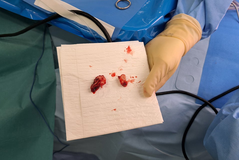 Surgeon showing two parts of a mandible removed during a TMJ surgery