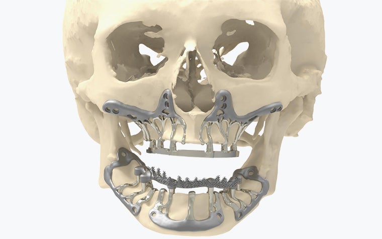 An image of a skull with a lower jaw bone implant.