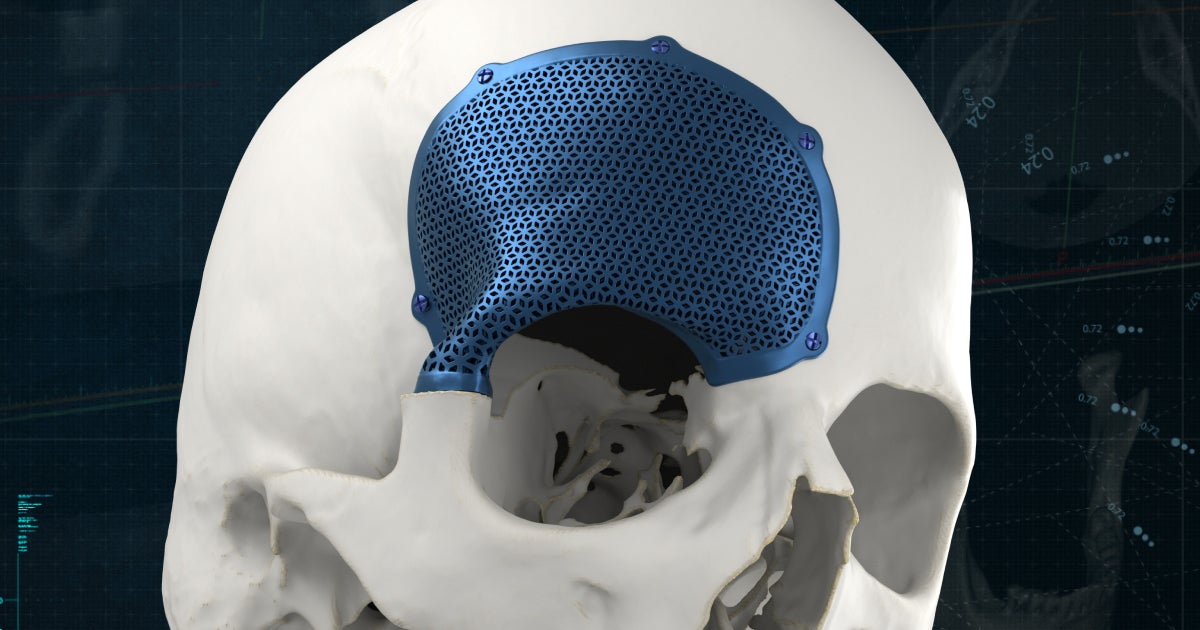 Neurosurgery | 3D-Printed Cranial Implants And 3D Planning