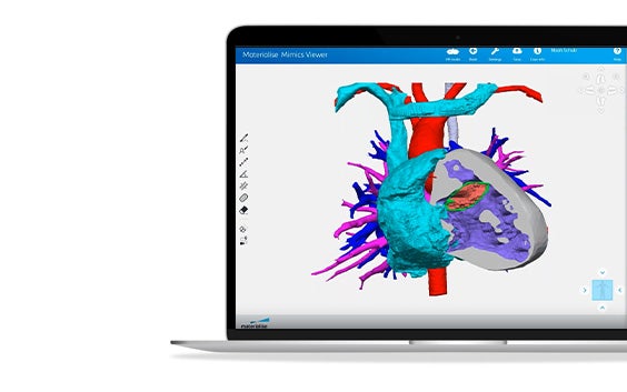 ssm-materialise-mimics-core-3d-segmented-heart-model.jpg