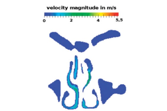 Visual showing a simulated pattern on the patient's nasal passage