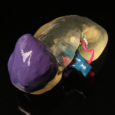 3D-Printed Kidney Model Allows Surgeons to Successfully Transplant Adult Kidney into Two-Year-Old