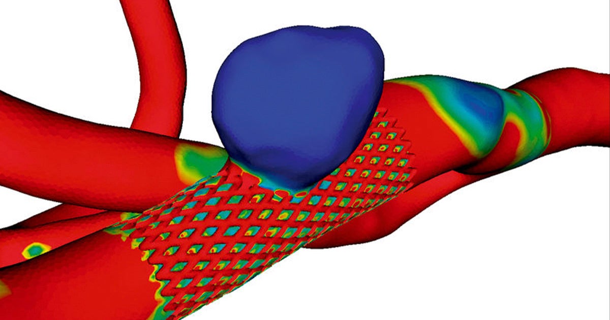Custom Aneurysm Treatment that Saves Lives | Materialise