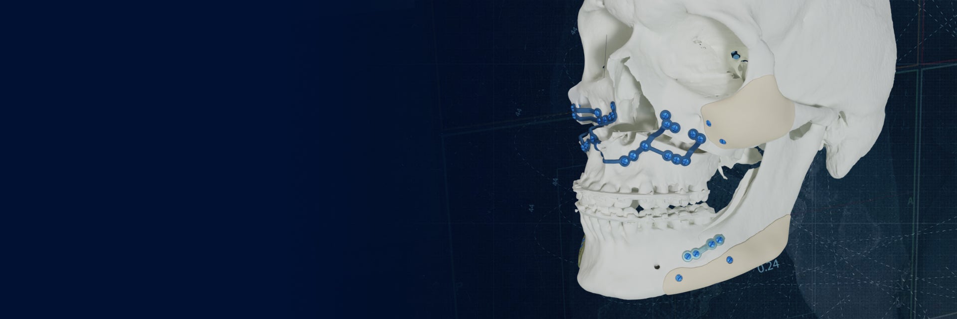 Modèle de crâne avec des plaques de titane imprimées en 3D sur fond bleu.