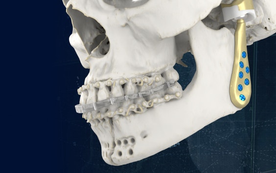 TMJ Total Arthroplasty | Personalized Implants and Guides