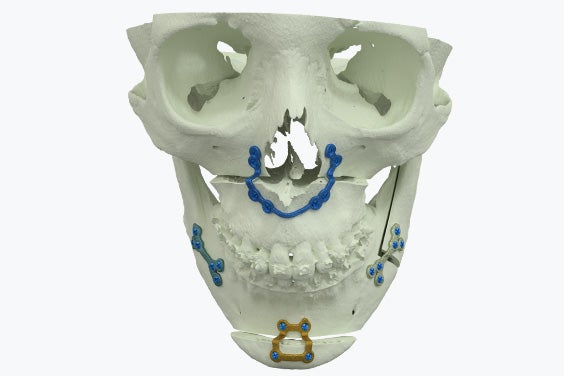 Un modèle de crâne sur lequel sont fixées des plaques personnalisées en titane