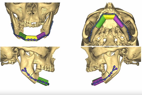 Four angles showing a 3D model of a patient's skull with personalized, 3D-printable plates attached to the mandible
