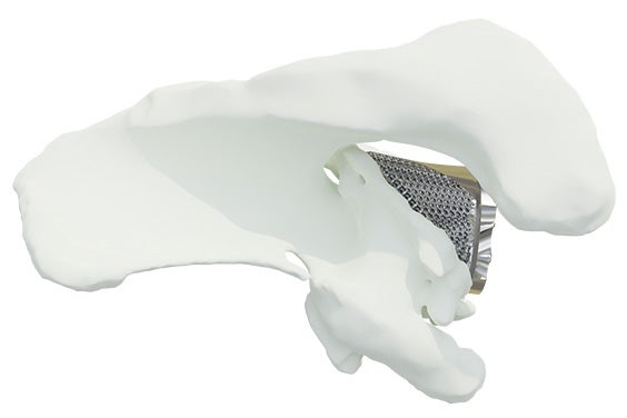 Virtual model showing the top view of a personalized Glenius implant in a shoulder