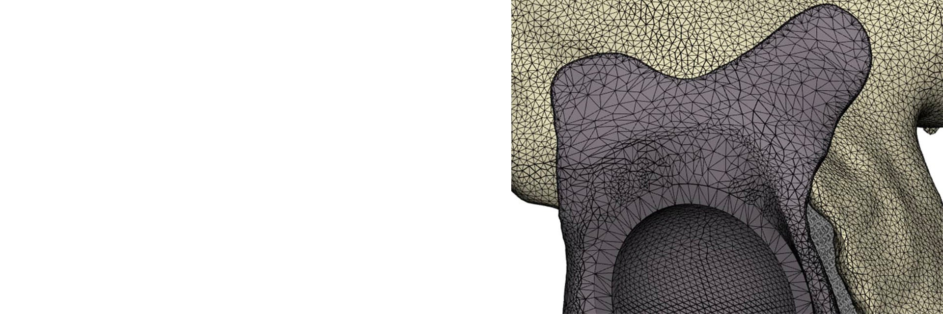 STL file of a personalized implant in anatomy