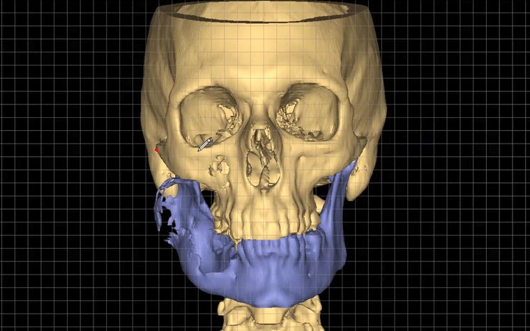 Virtual Planning for Mandibular Reconstruction Surgery with Mimics Enlight CMF