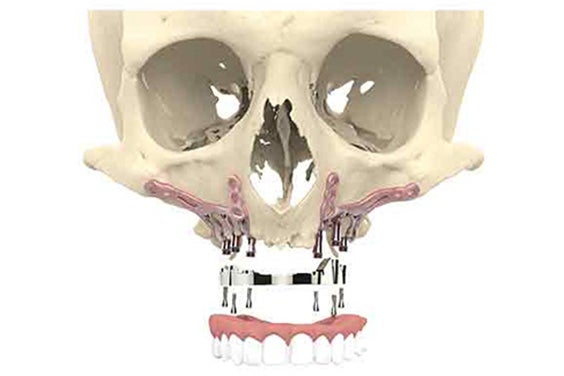 歯を頭蓋骨に取り付けるインプラントを装着した頭蓋骨模型の正面図