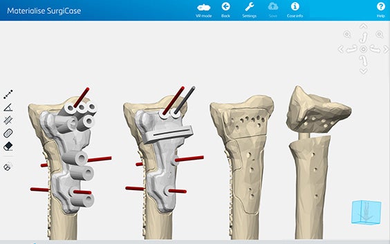 Revista Brasileira de Ortopedia - Treatment of Distal Radio Vicious  Consolidation: Corrective Osteotomy Through 3D Printing  Prototyping<sup>*</sup>