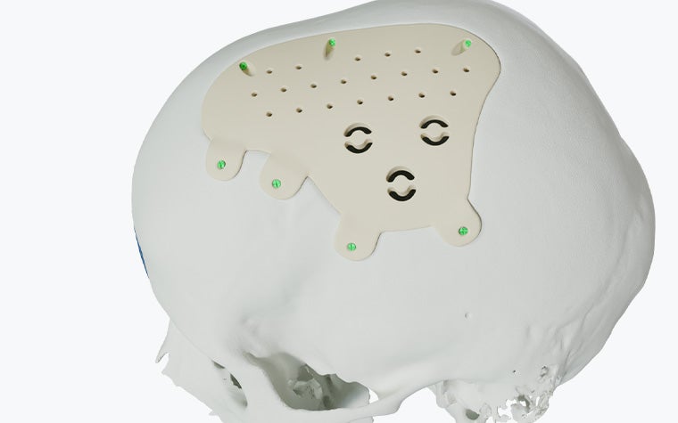 A digital skull model with a PEEK cranial implant secured by green screws, featuring multiple small perforations and three larger openings.