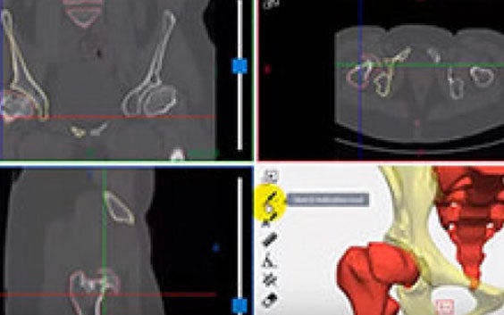 Performing Measurements and Providing Annotations in Mimics Viewer