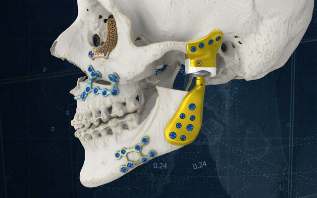 TMJ Total Arthroplasty | Personalized Implants and Guides